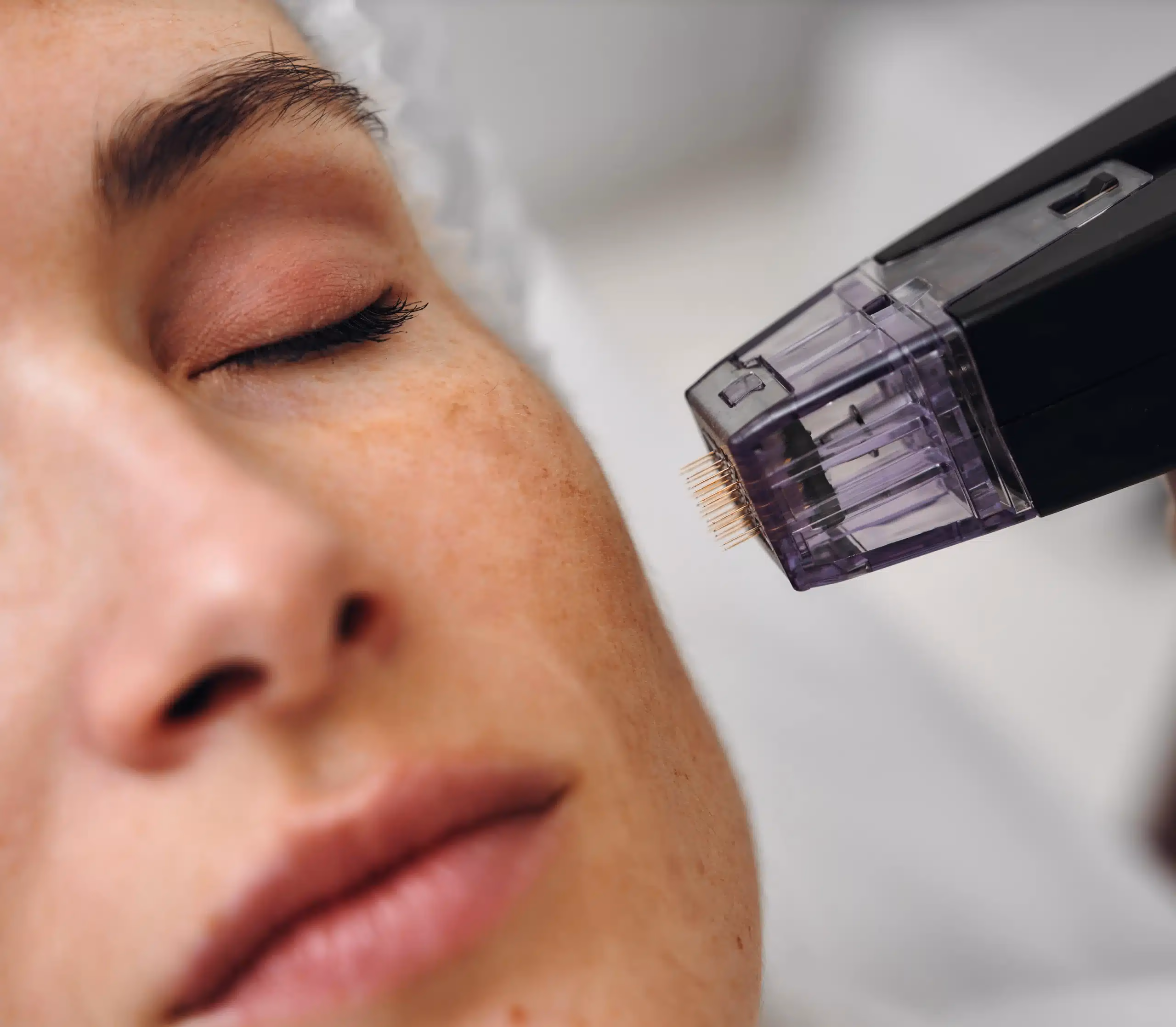 Microneedling: how it works